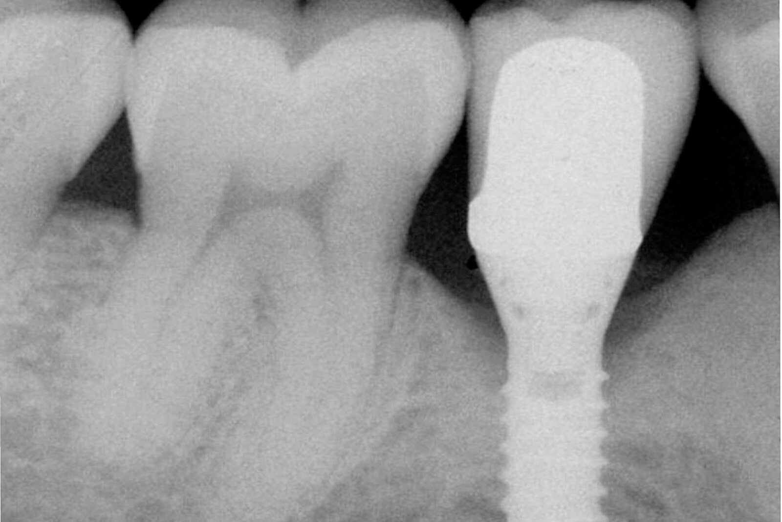 Geistlich UK: Peri-Implantitis